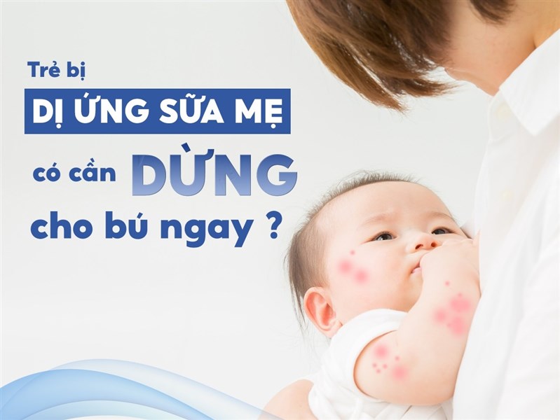 Trẻ bị dị ứng sữa mẹ có cần dừng cho bú ngay?